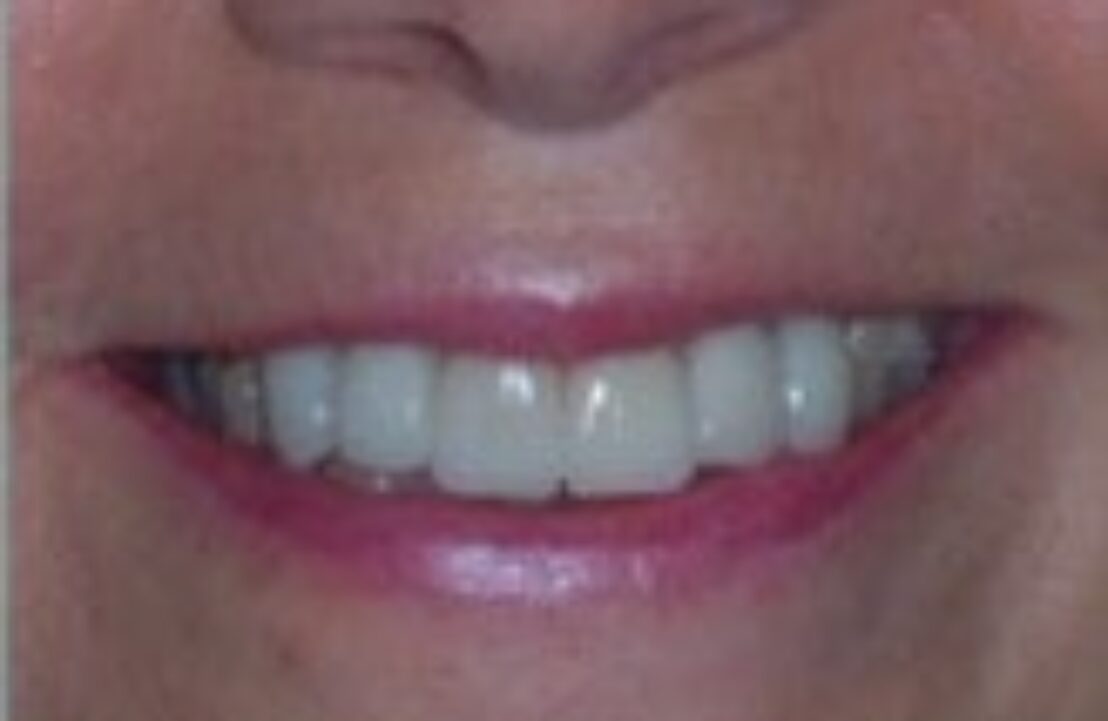 After - Abbey Mead Dental & Implant Clinic