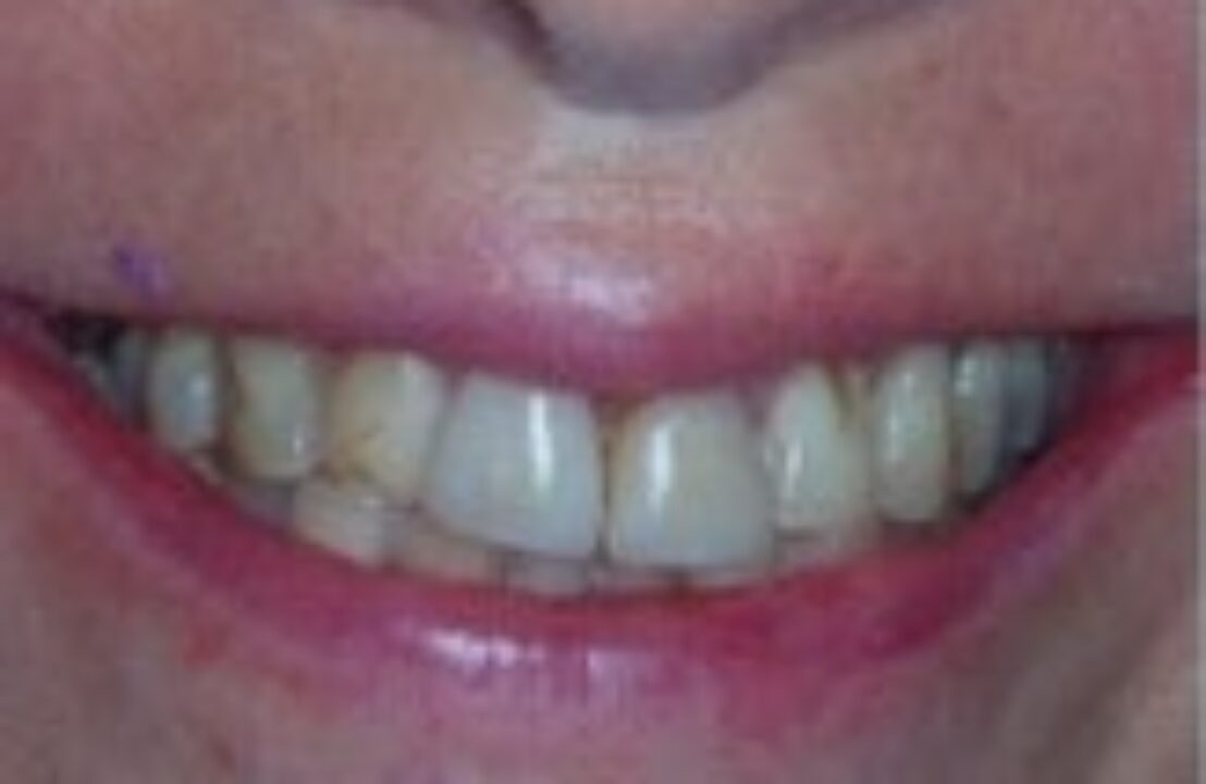 Before - Abbey Mead Dental & Implant Clinic