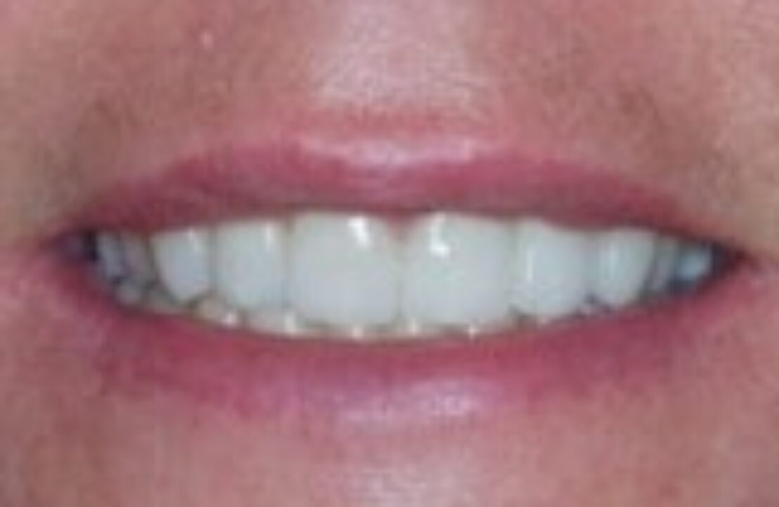 After - Abbey Mead Dental & Implant Clinic