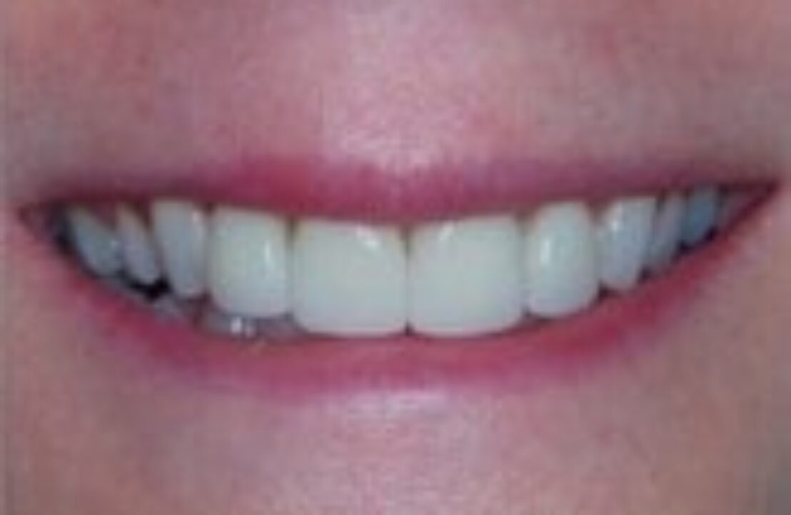 After - Abbey Mead Dental & Implant Clinic