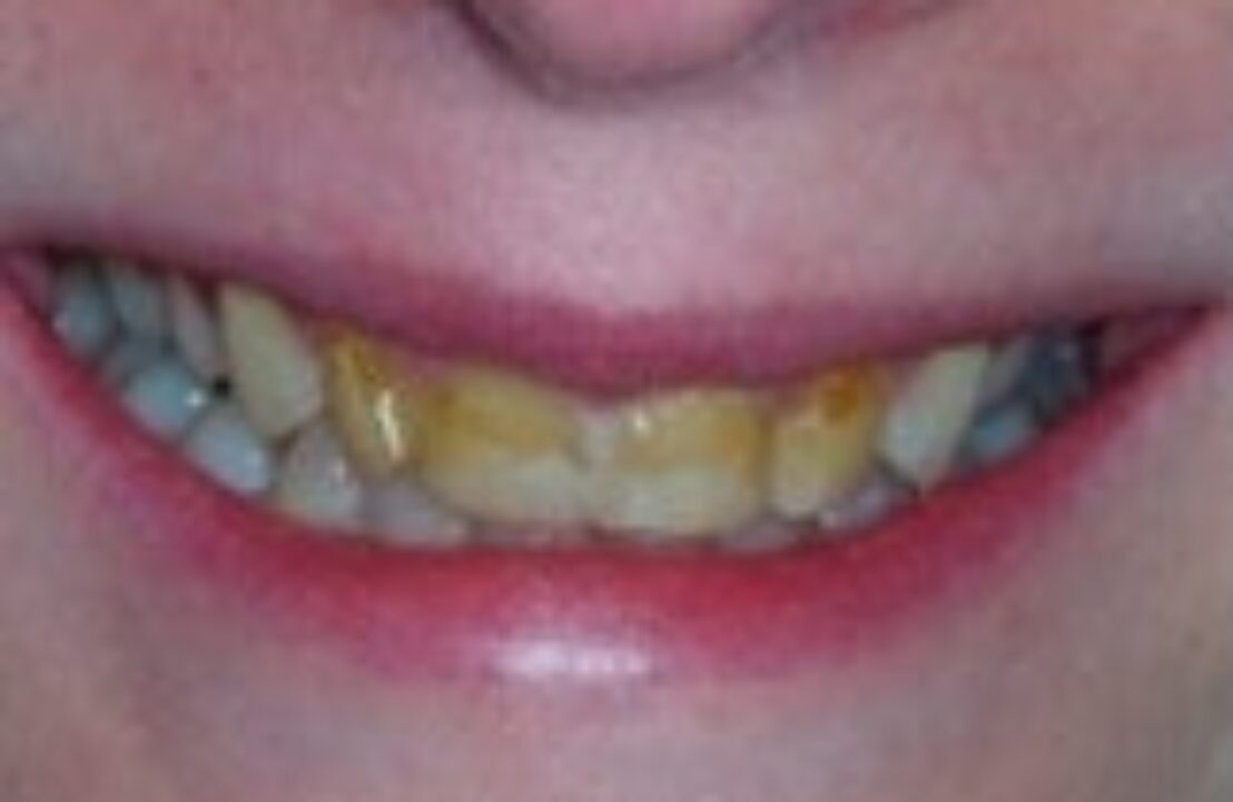 Before - Abbey Mead Dental & Implant Clinic